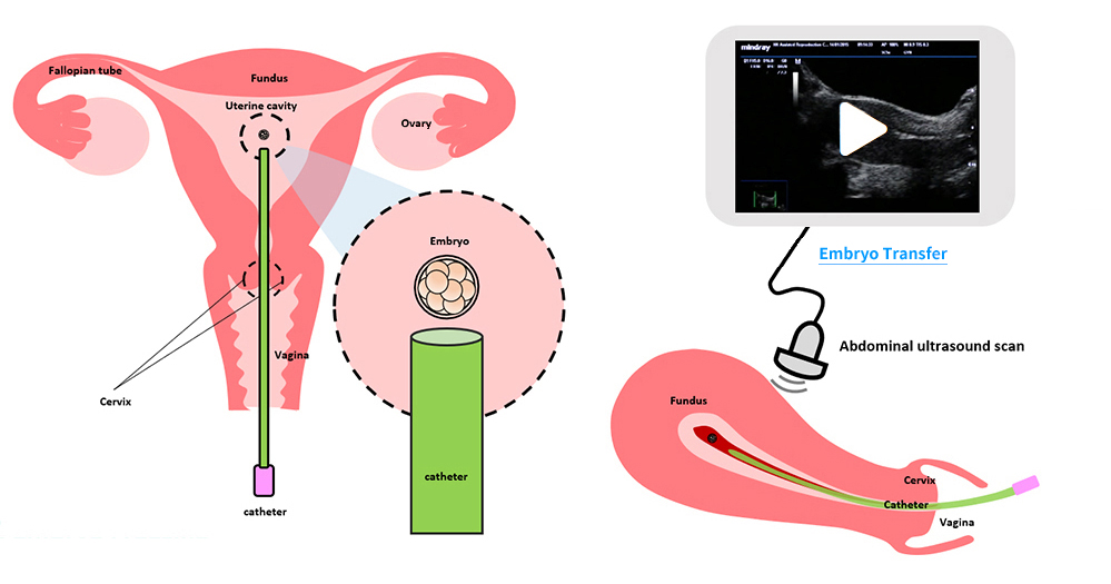 Embryo transfer